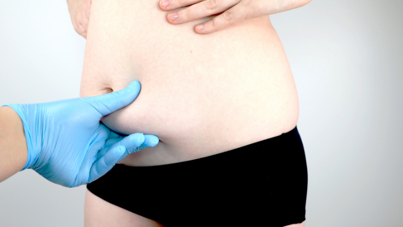 As recomendações essenciais no pós-operatório da abdominoplastia são apresentadas por Dr. Milton Seigi Hayashi.